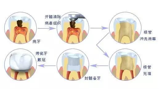 根管治疗不做冠,牙齿迟早留后患