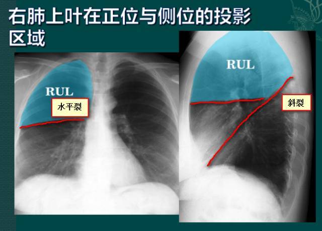 影像医师看过来～读完此文,胸部x线阅片再也不怕了