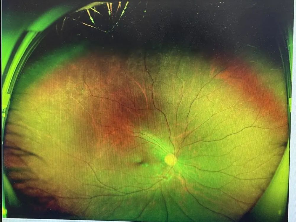 眼底检查发现视网膜裂孔
