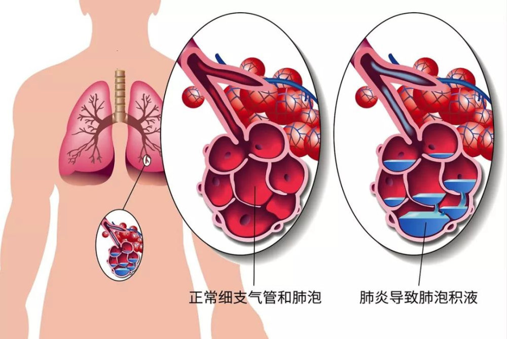 高原肺水肿 (hape)和 高原脑水肿 (hace).