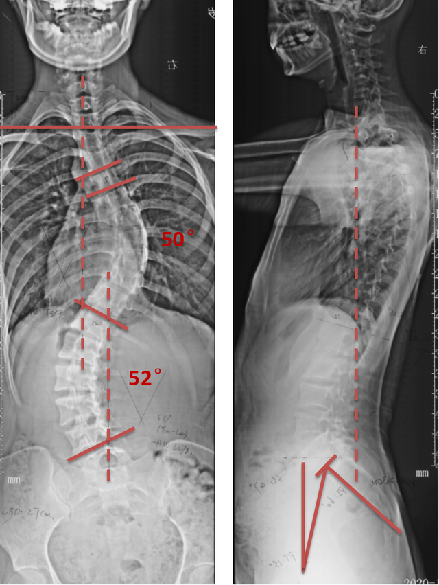病例:青少年特发性脊柱侧凸畸形(ais)