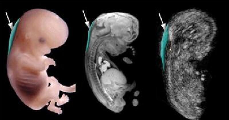 "胎儿畸形"危险期:过了这个月份,孕妈就可以把心放肚子里了