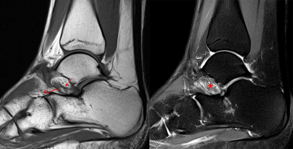 您应该要知道的跗骨窦综合症,mri 影像表现又如何