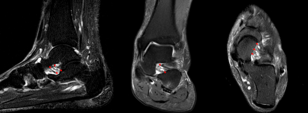 您应该要知道的跗骨窦综合症,mri 影像表现又如何