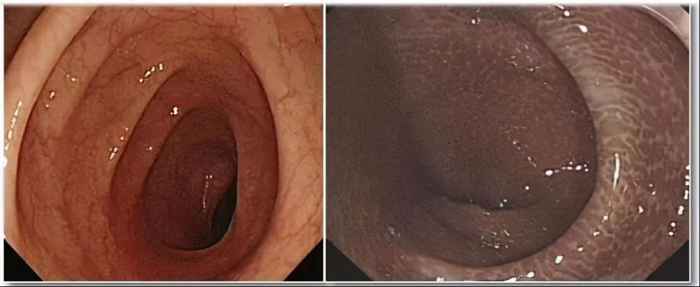 正常结肠vs结肠黑变病