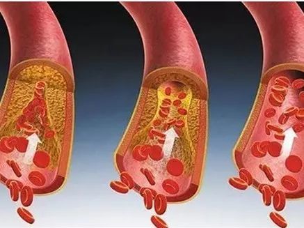 保持血管健康,预防动脉粥样硬化!