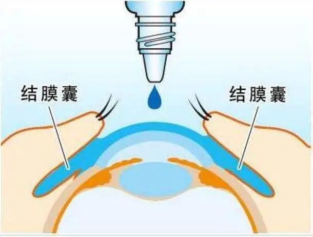 因结膜囊容纳液体量仅20ml,而1滴滴眼液体积约39ml,加之角膜组织屏障