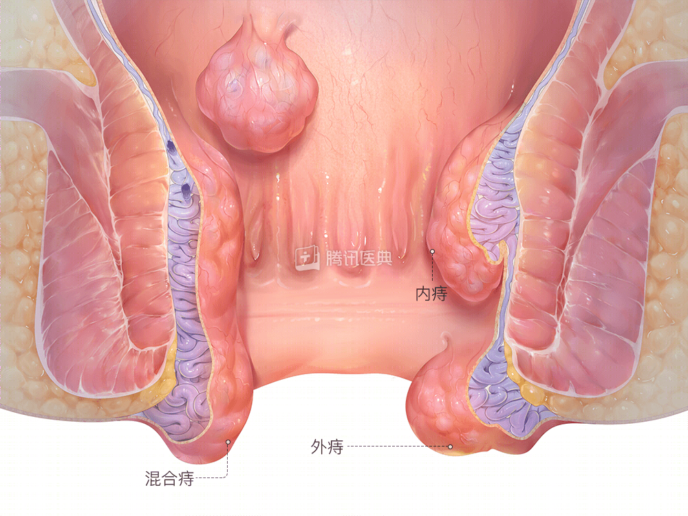 24岁女生自曝痔疮手术全过程:最疼时"就像玻璃渣扎进肉里"!