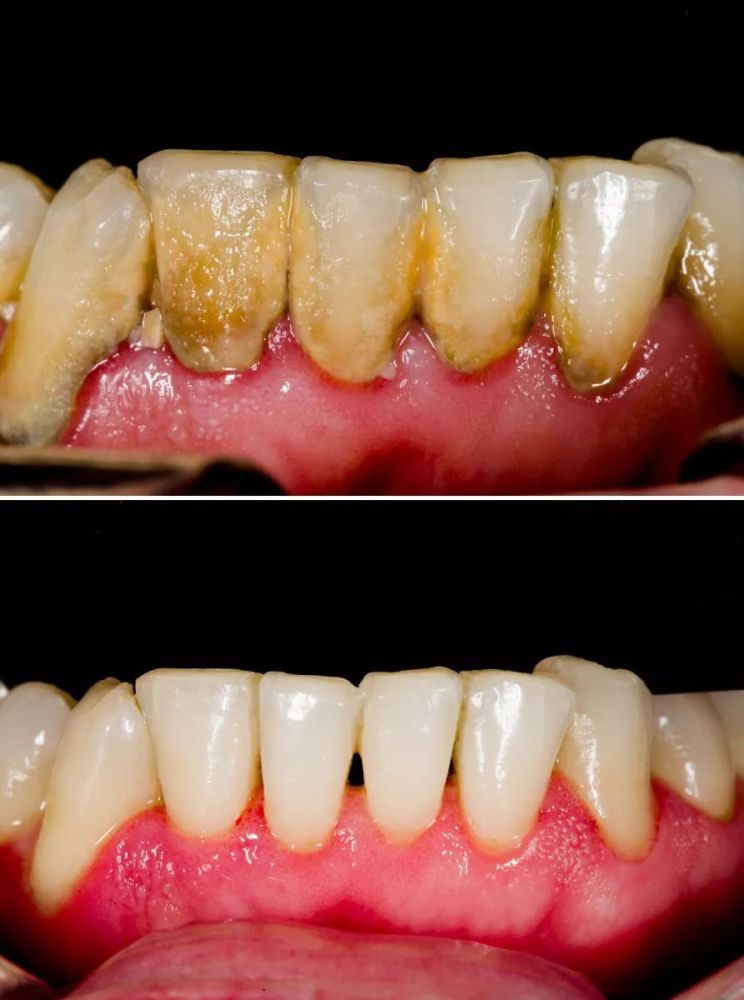 因为洗牙之前牙结石填塞了牙缝,洗牙之后牙结石被清除掉,牙缝就会显得