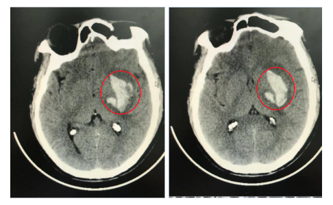 入院时头颅ct影像,红色圈内为出血点 医院供图
