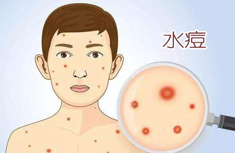 水痘传染性极强,水痘病人是唯一的传染源,病毒存在于病人上呼吸道和