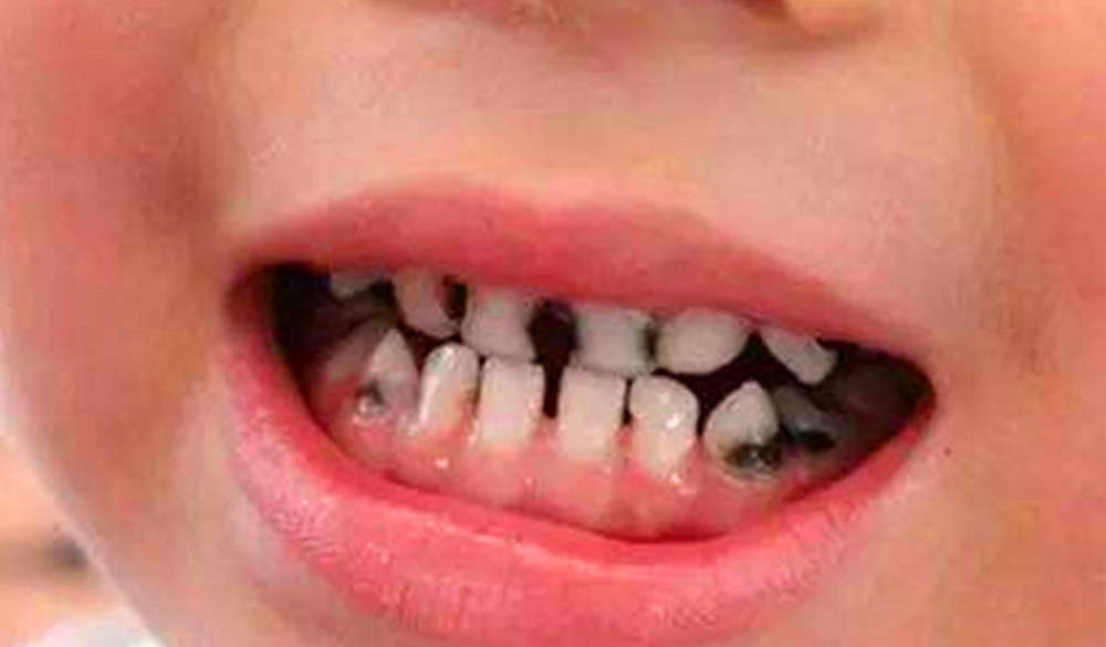 父母千万不要忽略孩子的乳牙,认为乳牙迟早要换,所以就不用在意.