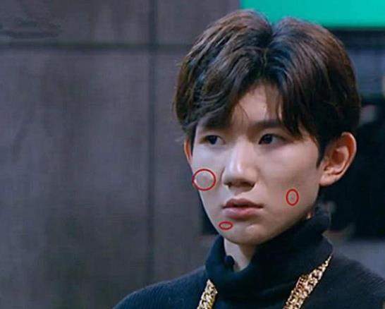 王源脸上的痘痘越发严重,从脸颊长到耳根,节目美颜都拯救不了
