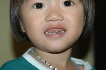 2岁孩子出现"小黑牙",和糖果没有关系,是父母的坏习惯