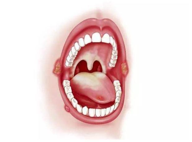 口腔溃疡反反复复,痛的吃不下饭怎么办?4个食疗方好的