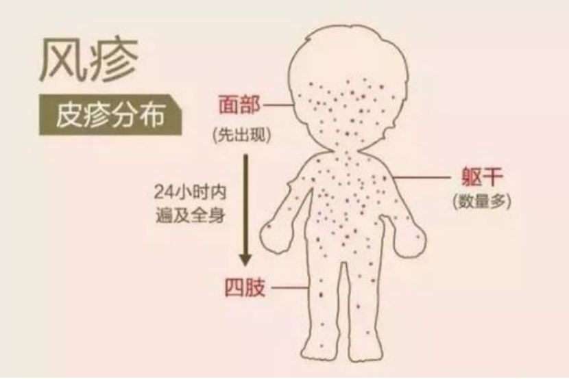 小儿发热伴皮疹护理措施(二)