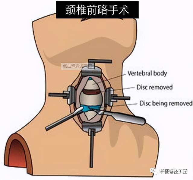 微创理念颈前路手术治疗多节段复杂性颈椎病