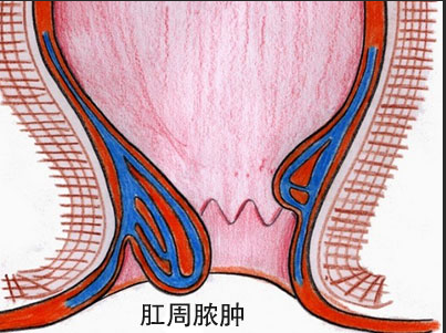 患者常因肛门周围有肿块且疼痛难忍前来就诊,这种疼痛十分剧烈,且