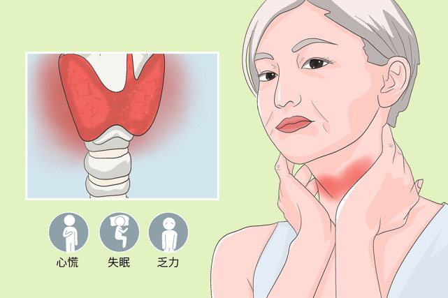 这6类人更容易得甲状腺结节|甲状腺结节|甲状腺功能|结节