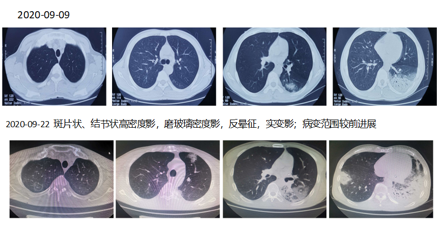 诊断为过敏性肺炎