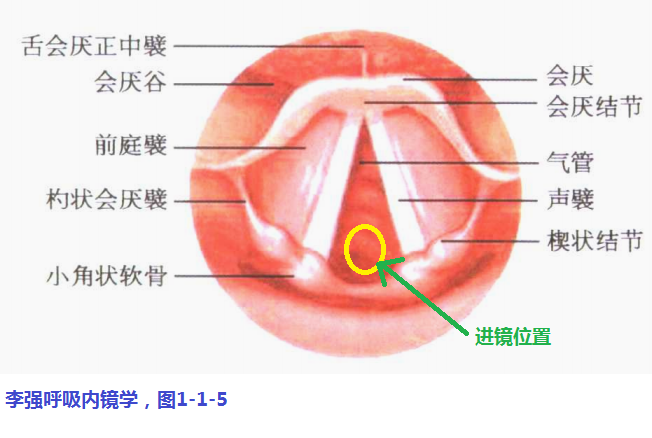 图8声门的下1/3比较宽敞,是进镜的首选位置,标准的操作方法是待声门