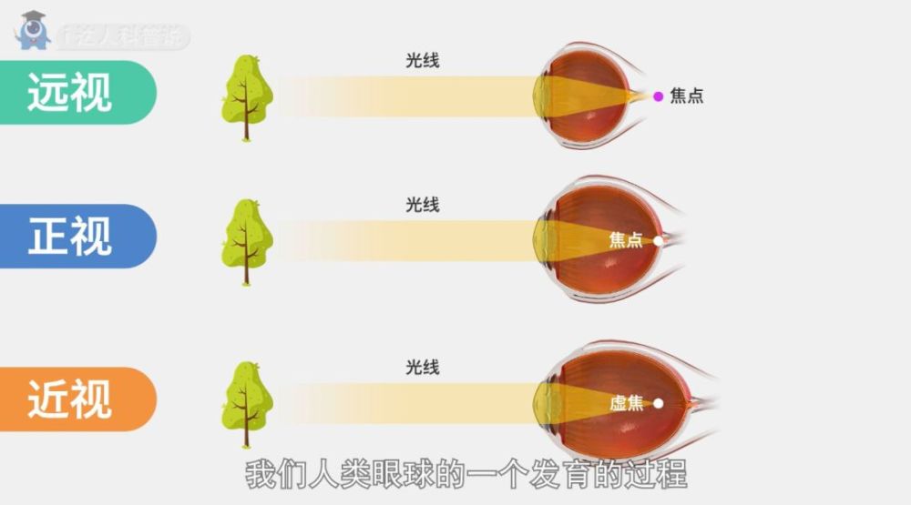 科普|眼轴长度评估在近视防控中的重要作用!