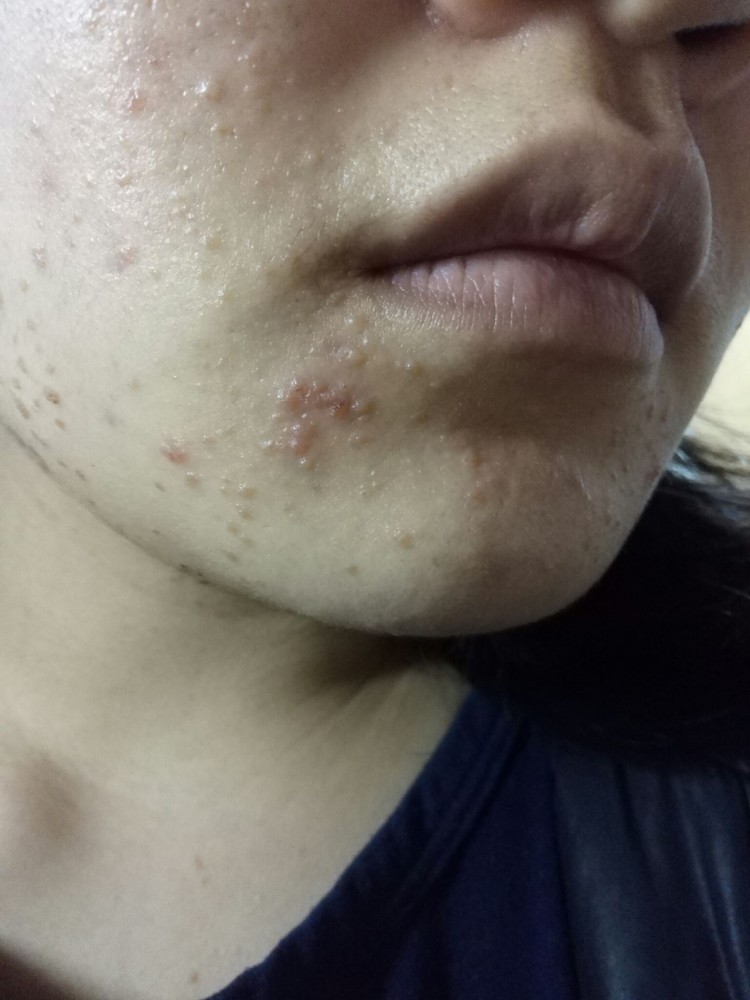 所以长在脸上的皮疹不一定都是痘痘也可能是扁平疣,尤其是扁平疣这类