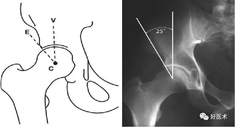 描述,在骨盆前后位x线片上,c点定义为股骨头的中心,e点为髋臼最外侧处