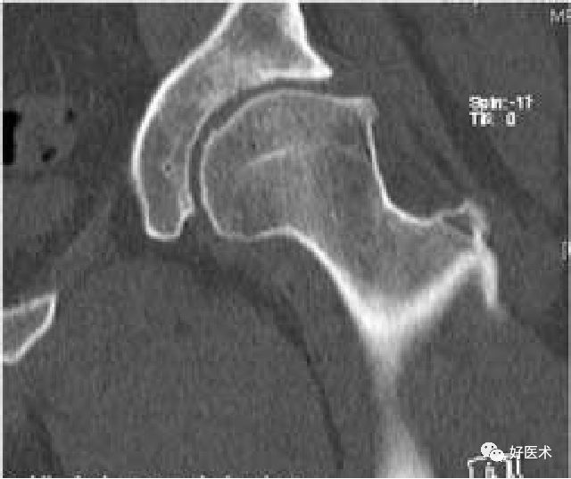 ct表现与x线平片相同 能更清晰显示细微骨质结构改变:髋臼边缘的骨赘