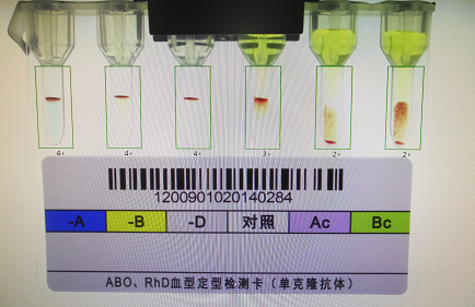 ab型血反定竟然出现凝集|ab型血|血型|抗体|细胞