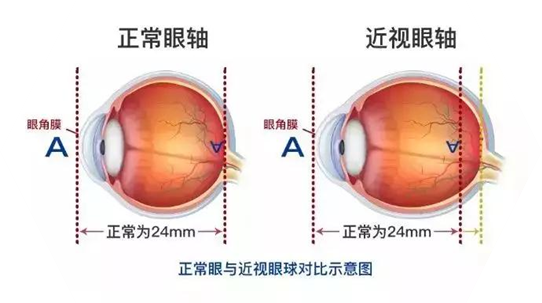 近视200度不等于安全!专家赵瑞博:26毫米以上是危险眼轴