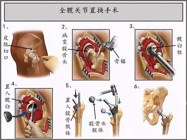 8,什么是全髋关节置换术?