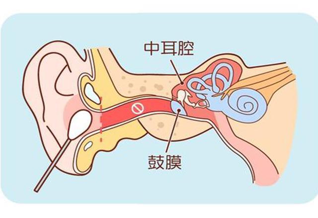 鼓膜破了就会聋修复后听力能恢复正常吗这2种情况可以自愈