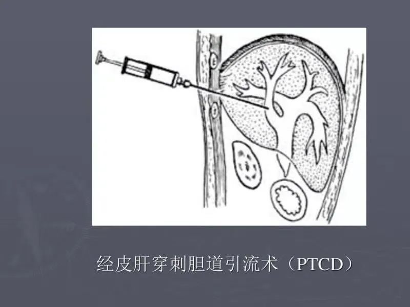 经肝胆囊穿刺置管引流术(ptgd/经皮经肝肝胆管穿刺置管引流术(ptcd)