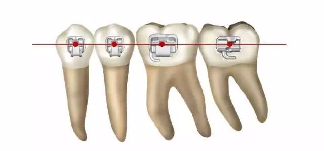 下颌前牙托槽位置:托槽槽沟中心点和临床牙冠中心点重合,尖牙托槽粘
