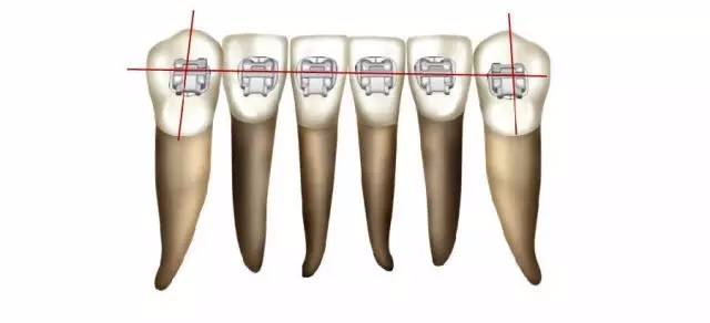 正畸托槽定位原则,让你贴好每个托槽