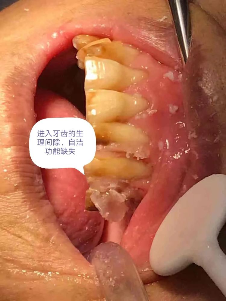 拆完以后:发现患者口腔中仍残留大量尖锐牙根,并且牙龈红肿严重,口腔
