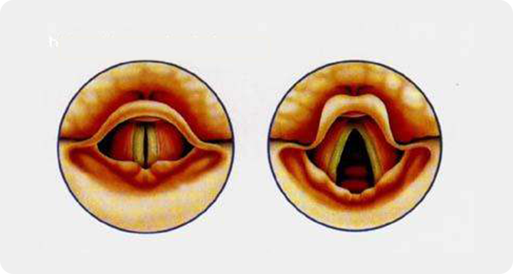 北京喉科专家高丹红声带息肉的原因与治疗解析