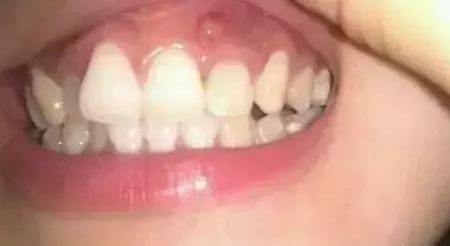 这牙龈上长了个小包的话,很难忍住不去舔舔,看看,甚至想自己动了挤了.