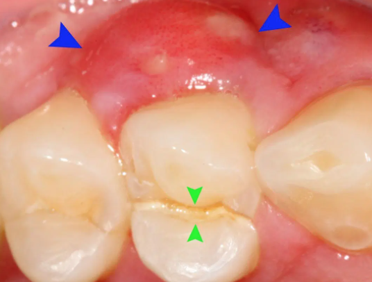 有坏牙可能牙槽脓肿牙龈上的小脓包怎么起来的?