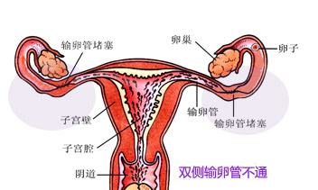 输卵管,能不能给点儿力,别总拖后腿?
