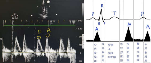 左室舒张功能 ea 峰:二尖瓣舒张期血流频谱的两个峰值,分别对应心室