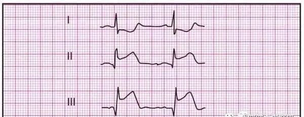 10分钟快速掌握急性心梗的心电图判读
