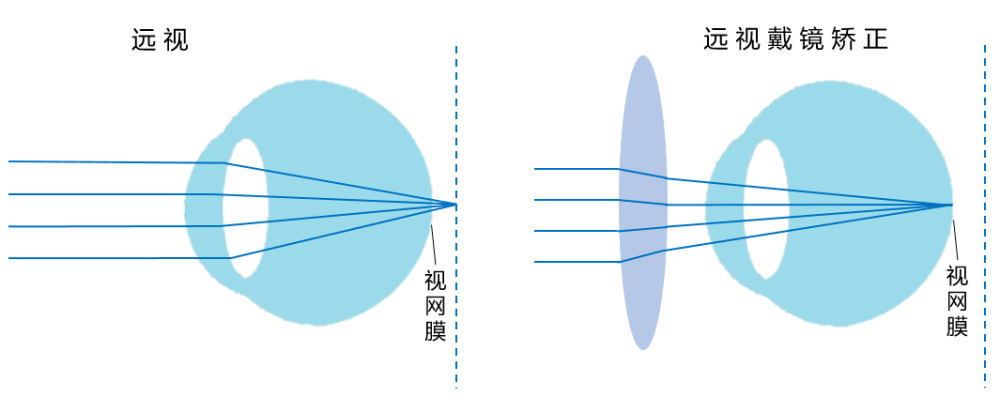 "科普"近视,远视,散光,老花,我到底属于哪一种?