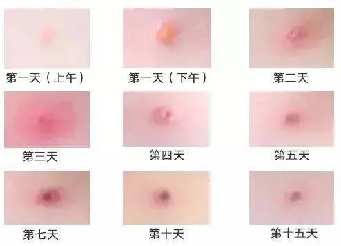 对水痘—带状疱疹病毒感染者主要是对症处理,目前无特效治疗方法