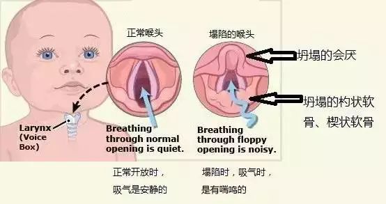 从下面的两张对比示意图可以看出,左边正常的喉头,声门上的结构(会厌