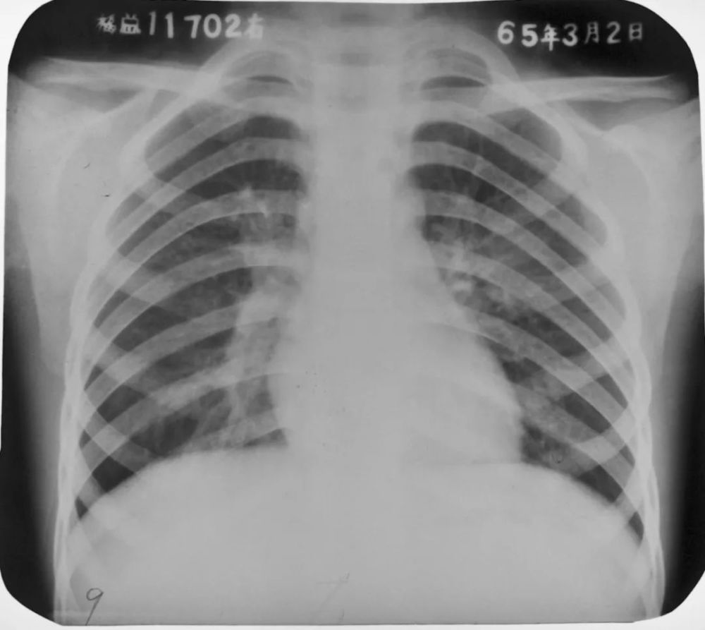 胸片如何看肺炎,这篇文章帮你立刻入门!