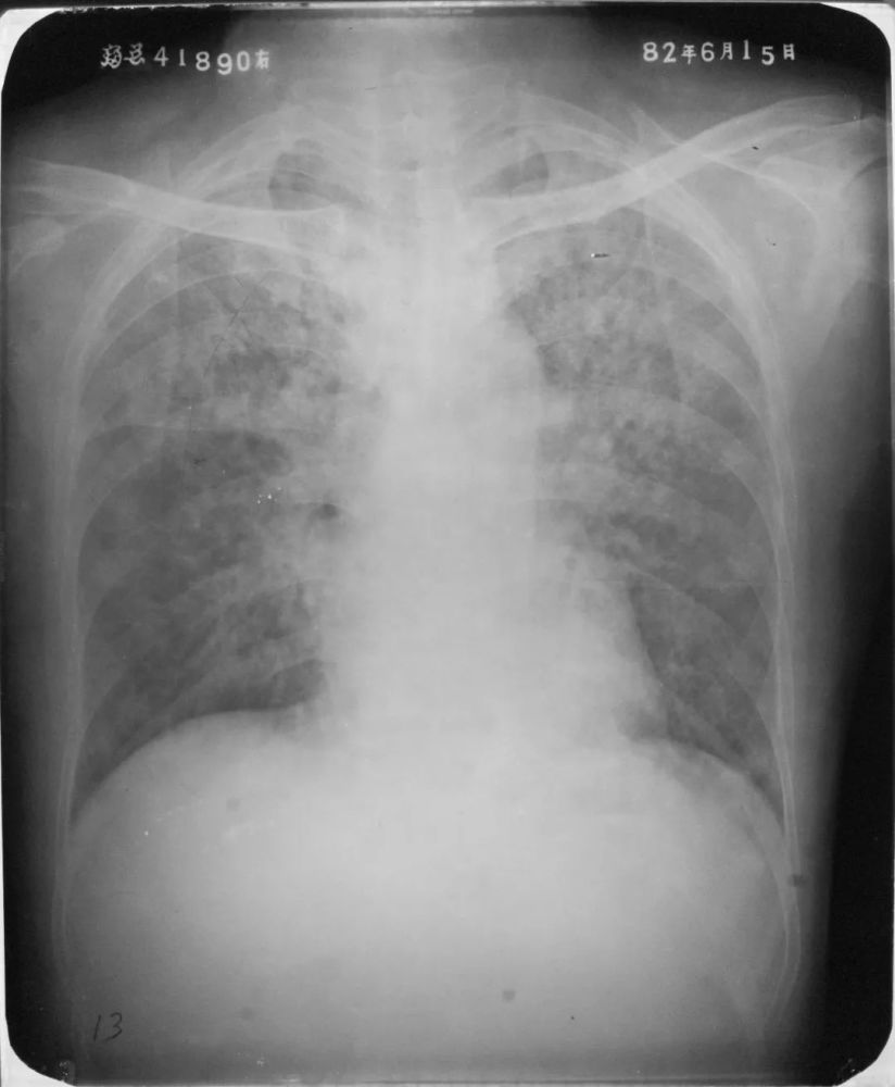 胸片如何看肺炎,这篇文章帮你立刻入门!