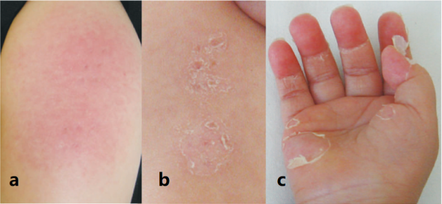 幼儿急疹:这个最常见的发热出疹疾病,你肯定不敢诊断