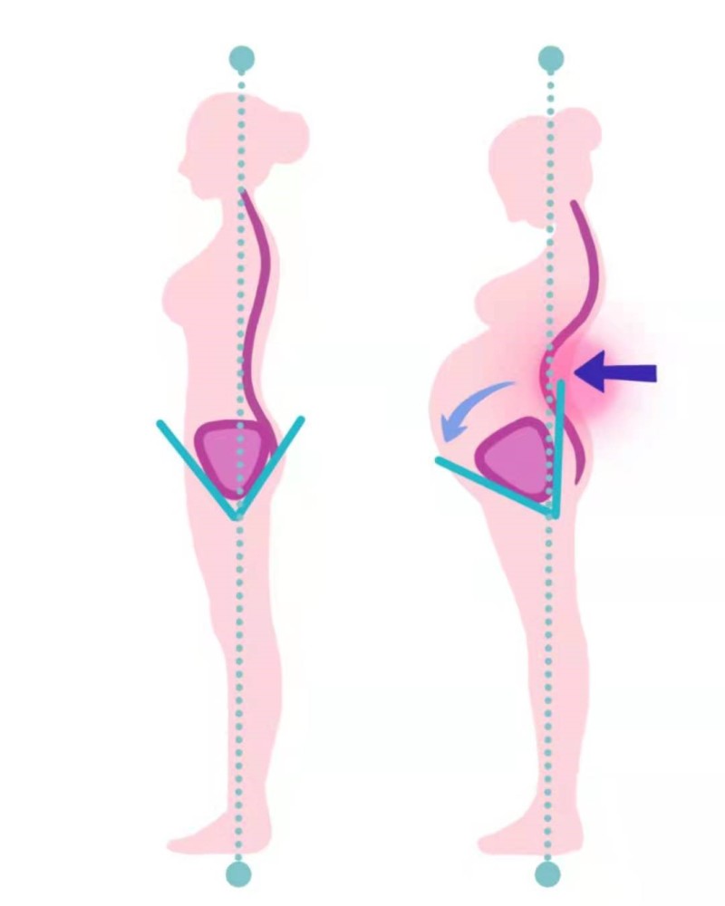 (图1 孕期骨盆前倾和腰椎前凸增加示意图)